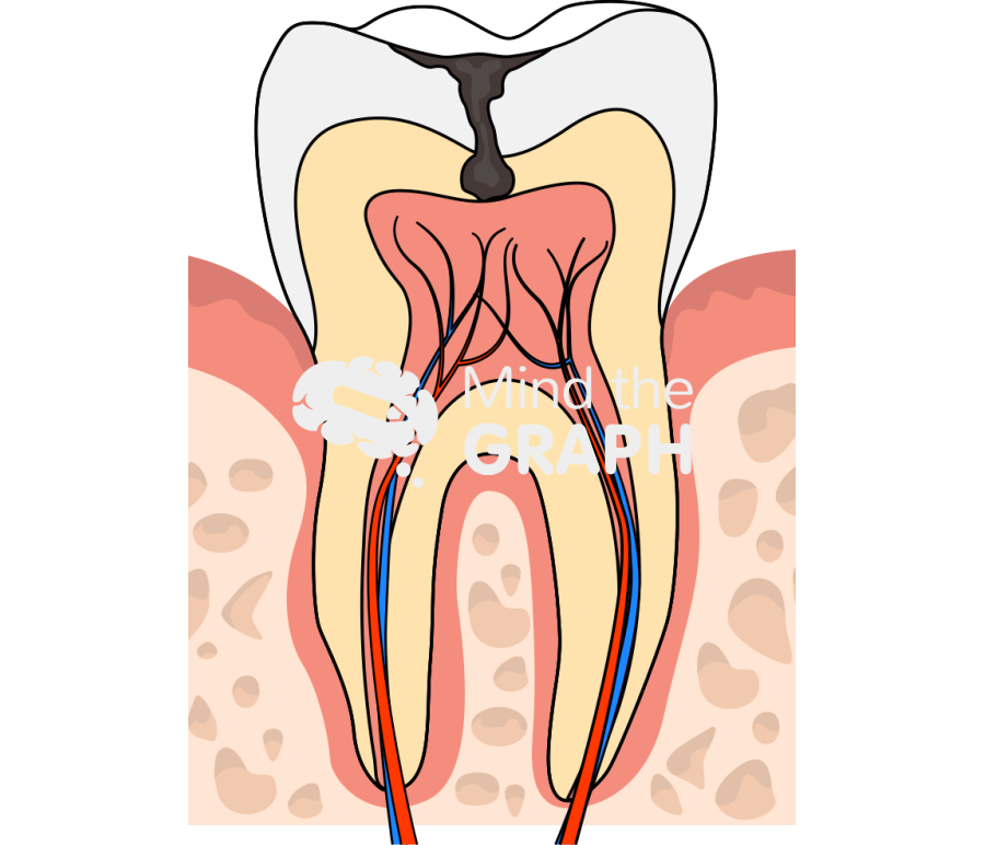 Tooth decay cavity Icons, Symbols, Pictures, and Images